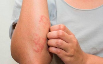 Campaña de detección gratuita de la psoriasis en el Hospital Cordero