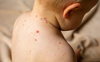 Sarampión: es importante vacunar y en nuestra región sanitaria agregar la ‘dosis cero’